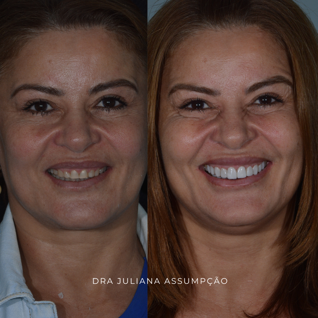 antes x depois rosto 1